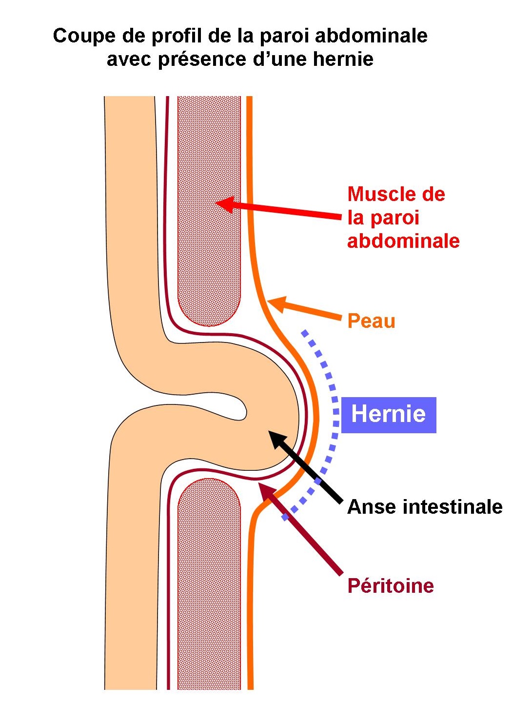 Quelle Est La Différence Entre Hernie Ombilicale Et Hernie Inguinale FNVV — free download